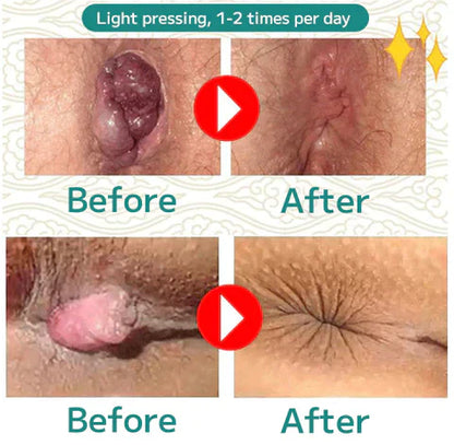 Capsules Herbeuses Anti-Hémorroïdes ORIGINALE